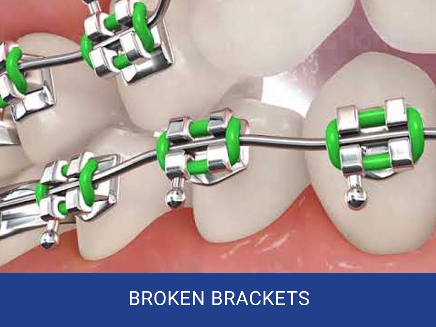 Broken Brackets