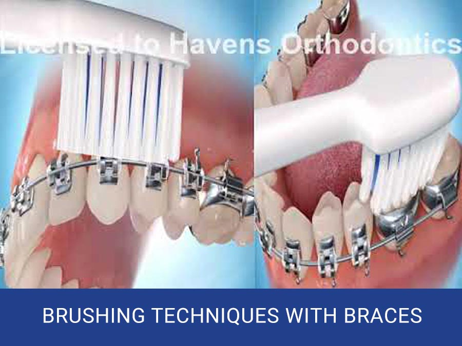 Brush Techniques with Braces