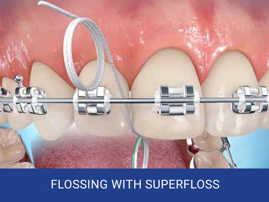 Flossing With Superfloss
