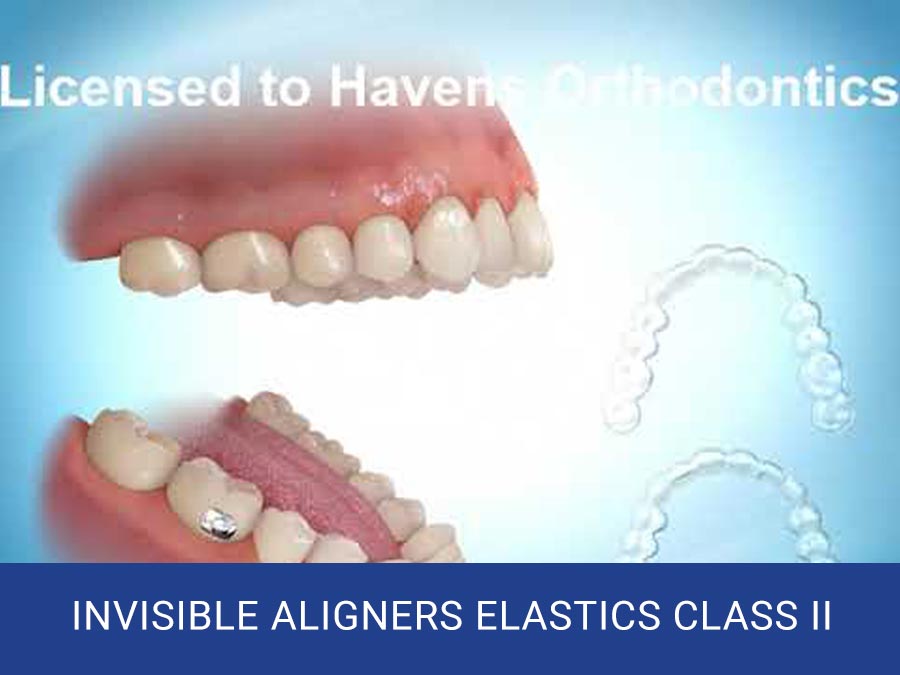 Featured image for “Invisible Aligners Elastics Class II”